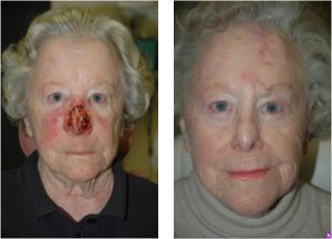 Before & After Subtotal nasal defect - Subtotal nasal defect requiring regional forehead flap reconstruction.
