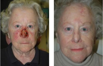 Subtotal nasal defect - Subtotal nasal defect requiring regional forehead flap reconstruction.