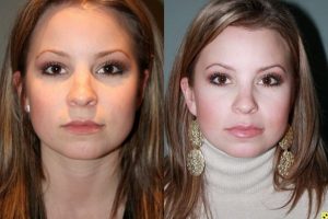 Before & After French lip augmentation - 26 year old female 2 weeks after undergoing French lip augmentation with juvederm creating natural looking fuller lips.