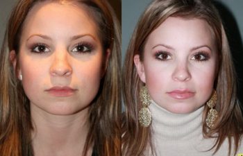 French lip augmentation - 26 year old female 2 weeks after undergoing French lip augmentation with juvederm creating natural looking fuller lips.