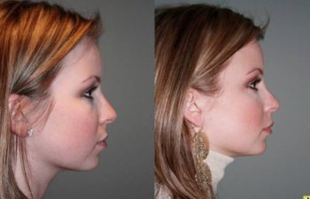 French lip augmentation - 26 year old female 2 weeks after undergoing French lip augmentation with juvederm creating natural looking fuller lips.