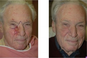 Before & After Combination local flap reconstruction - Problematic defect affecting two facial subunits requiring combination local flap reconstruction.