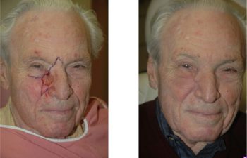 Combination local flap reconstruction - Problematic defect affecting two facial subunits requiring combination local flap reconstruction.