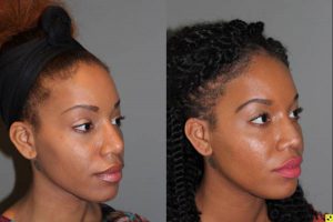 Rhinoplasty - 26 year old female 6 months following a revision ethnic rhinoplasty for a large bulbous tip following a primary rhinoplasty done by another surgeon