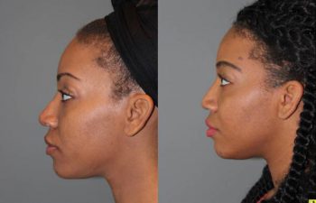 Rhinoplasty - 26 year old female 6 months following a revision ethnic rhinoplasty for a large bulbous tip following a primary rhinoplasty done by another surgeon