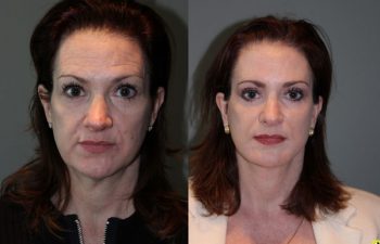 Mini Deep Plane Facelift & Upper and Lower Eyelid Blepharoplasty - 52 year old female 1 year post-op from upper and lower eyelid blepharoplasty and mini deep plane facelift​​.