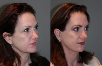 Mini Deep Plane Facelift & Upper and Lower Eyelid Blepharoplasty - 52 year old female 1 year post-op from upper and lower eyelid blepharoplasty and mini deep plane facelift​​.