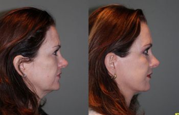 Mini Deep Plane Facelift & Upper and Lower Eyelid Blepharoplasty - 52 year old female 1 year post-op from upper and lower eyelid blepharoplasty and mini deep plane facelift​​.