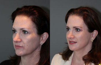Mini Deep Plane Facelift & Upper and Lower Eyelid Blepharoplasty - 52 year old female 1 year post-op from upper and lower eyelid blepharoplasty and mini deep plane facelift​​.