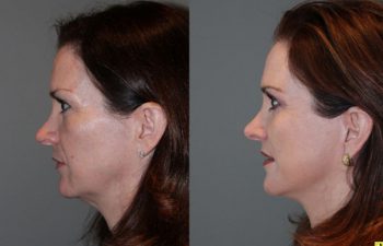 Mini Deep Plane Facelift & Upper and Lower Eyelid Blepharoplasty - 52 year old female 1 year post-op from upper and lower eyelid blepharoplasty and mini deep plane facelift​​.