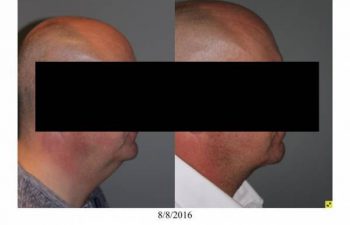 Neck Lift performed in office - 55 year old male 5 months post op direct necklift performed in office awake using only local anesthesia