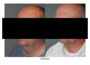 Neck Lift performed in office - 55 year old male 5 months post op direct necklift performed in office awake using only local anesthesia