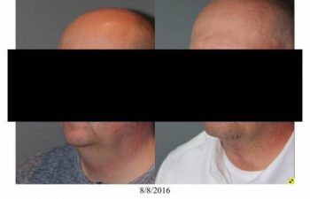 Neck Lift performed in office - 55 year old male 5 months post op direct necklift performed in office awake using only local anesthesia
