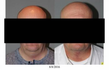Neck Lift performed in office - 55 year old male 5 months post op direct necklift performed in office awake using only local anesthesia