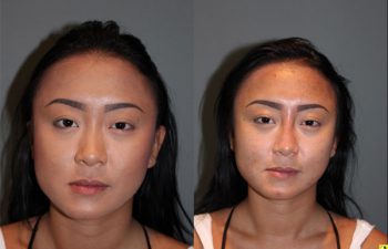Liquid Rhinoplasty - 23 year old female with a flat nasal bridge immediately after liquid rhinoplasty to increase the projection of the bridge of her nose.