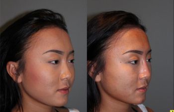Liquid Rhinoplasty - 23 year old female with a flat nasal bridge immediately after liquid rhinoplasty to increase the projection of the bridge of her nose.