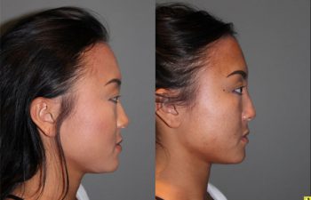 Liquid Rhinoplasty - 23 year old female with a flat nasal bridge immediately after liquid rhinoplasty to increase the projection of the bridge of her nose.