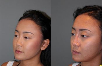 Liquid Rhinoplasty - 23 year old female with a flat nasal bridge immediately after liquid rhinoplasty to increase the projection of the bridge of her nose.
