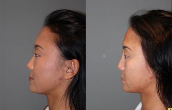 Liquid Rhinoplasty - 23 year old female with a flat nasal bridge immediately after liquid rhinoplasty to increase the projection of the bridge of her nose.