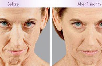 Juvederm Voluma® XC Treatment - Juvederm Voluma® XC was injected into the zygomatic arch, anteromedial cheek, and submalar region.