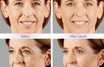 Juvederm Voluma® XC Treatment - Juvederm Voluma® XC was injected into the zygomatic arch, anteromedial cheek, and submalar region.