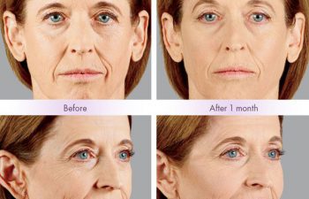 Juvederm Voluma® XC Treatment - Juvederm Voluma® XC was injected into the zygomatic arch, anteromedial cheek, and submalar region.