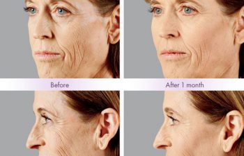 Juvederm Voluma® XC Treatment - Juvederm Voluma® XC was injected into the zygomatic arch, anteromedial cheek, and submalar region.