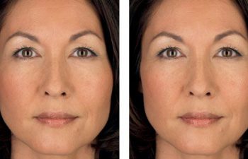 Juvederm® Eye Treatment - before and after 2 syringes of Juvederm® Ultra Plus.