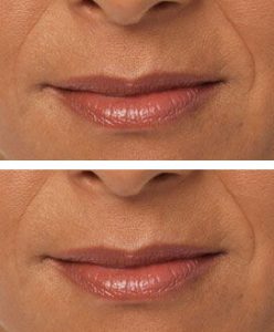 Juvederm® Lip Treatment - before and after 2 syringes of Juvederm® Ultra Plus.