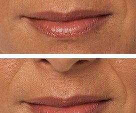 Juvederm® Lip Treatment - before and after 2 syringes of Juvederm® Ultra Plus.