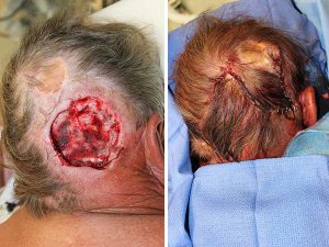 Before & After Large posterior Scalp Mohs Defect - Large posterior scalp Mohs defect closed using an opposing, rotation, advancement, multiflap closure technique.