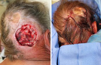 Large posterior Scalp Mohs Defect - Large posterior scalp Mohs defect closed using an opposing, rotation, advancement, multiflap closure technique.