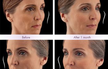 Juvederm Voluma® XC Treatment - Juvederm Voluma® XC was injected into the zygomatic arch, anteromedial cheek, and submalar region.