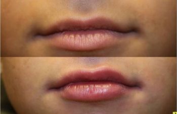 Juvederm Lip Injections - 19 year old female after bruise-free cannula injection of juvederm to upper and lower lips