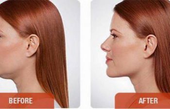 photos of a woman before and after a Kybella procedure