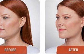 photos of a woman before and after a Kybella procedure