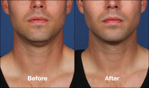 photos of a man before and after a Kybella procedure