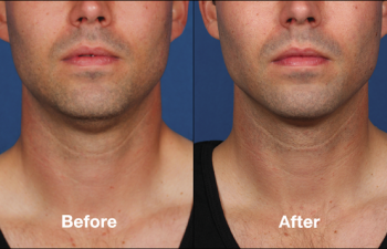 photos of a man before and after a Kybella procedure