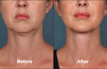 photos of a woman before and after a Kybella procedure
