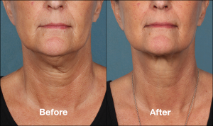 photos of a woman before and after a Kybella procedure