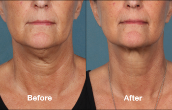 photos of a woman before and after a Kybella procedure