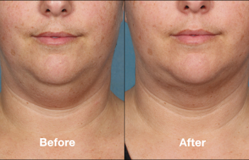 photos of a woman before and after a Kybella procedure