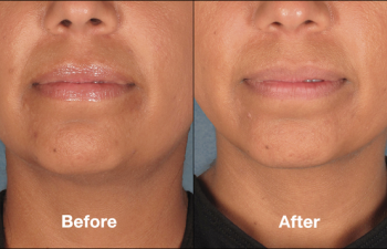 photos of a woman before and after a Kybella procedure