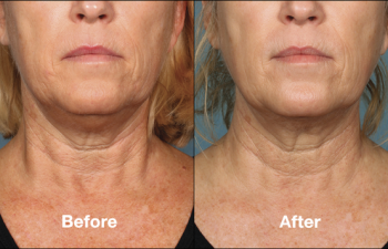 photos of a woman before and after a Kybella procedure