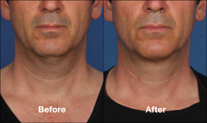 photos of a man before and after a Kybella procedure