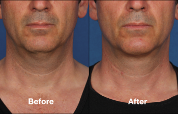 photos of a man before and after a Kybella procedure