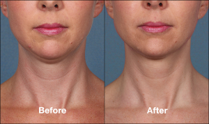 photos of a woman before and after a Kybella procedure