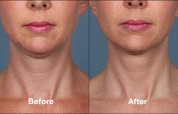 photos of a woman before and after a Kybella procedure
