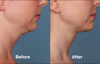 photos of a woman before and after a Kybella procedure