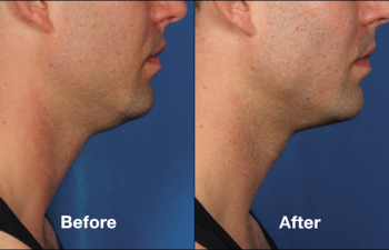 photos of a man before and after a Kybella procedure